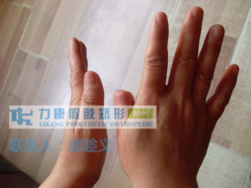 左拇指指节缺失(图1)
